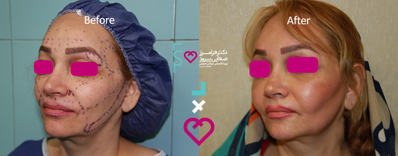 عکس قبل و بعد از تزریق ژل زیر چشم | عکس قبل و بعد تزریق چربی زیر چشم